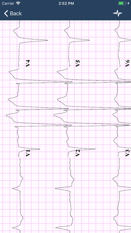 心电图指南（ECG Guide） 第1张图